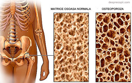 Fracturile sunt deseori provocate de osteoporoza